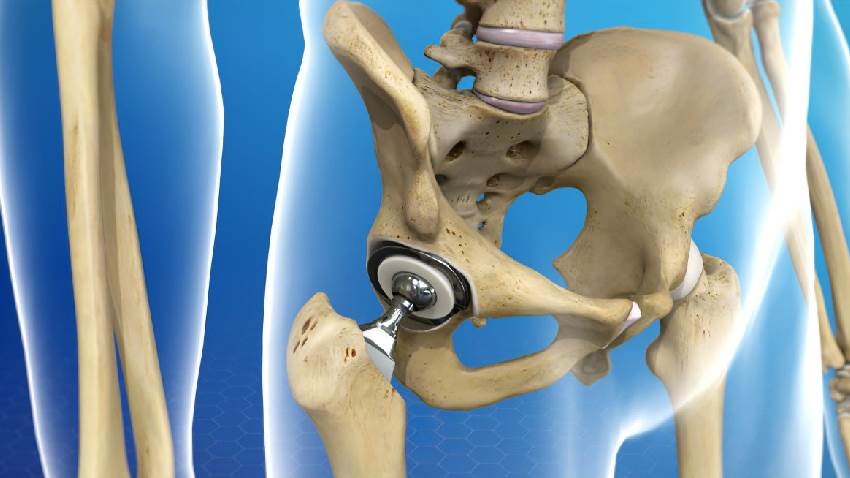 Особенности эндопротезирования